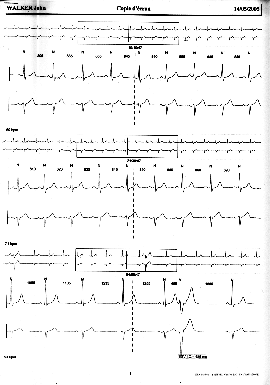 http://www.fourmilab.ch/fourmilog/archives/ecg1_a.png